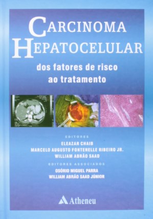 Carcinoma Hepatocelular - Dos Fatores De Risco Ao Tratamento