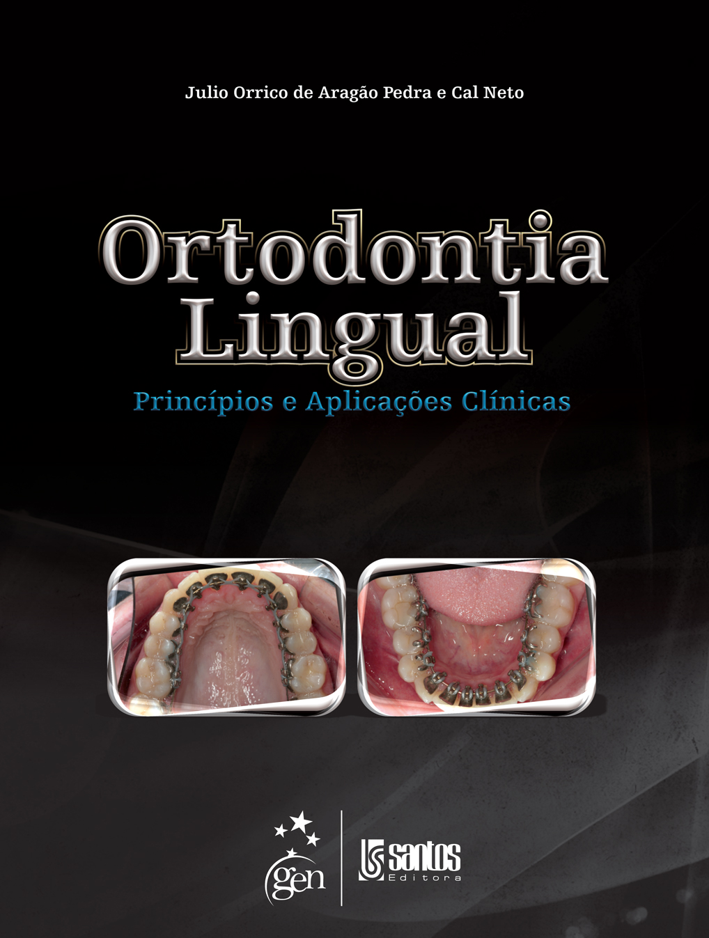 Ortodontia Lingual - Princípios E Aplicações Clínicas