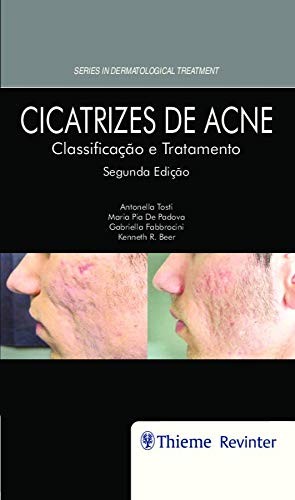 Cicatrizes De Acne Classificacao E Tratamento