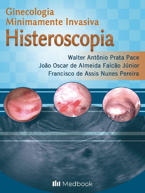 Histeroscopia: Ginecologia Minimamente Invasiva